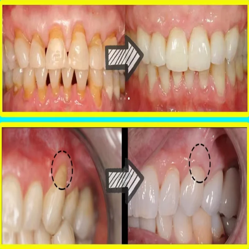 Quickly Repair Gum Serum Relie - đánh giá và giá Teeth Whitening With Baking Soda