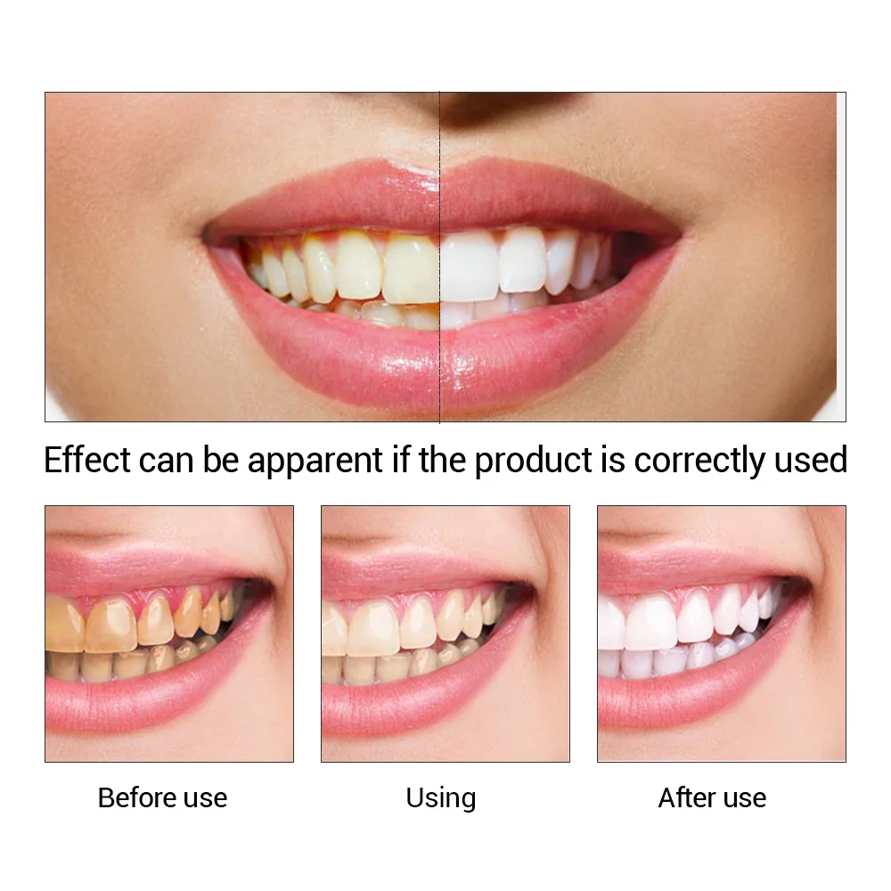 FTEENPLY Làm Trắng Răng Tinh C - đánh giá và giá Teeth Whitening Price