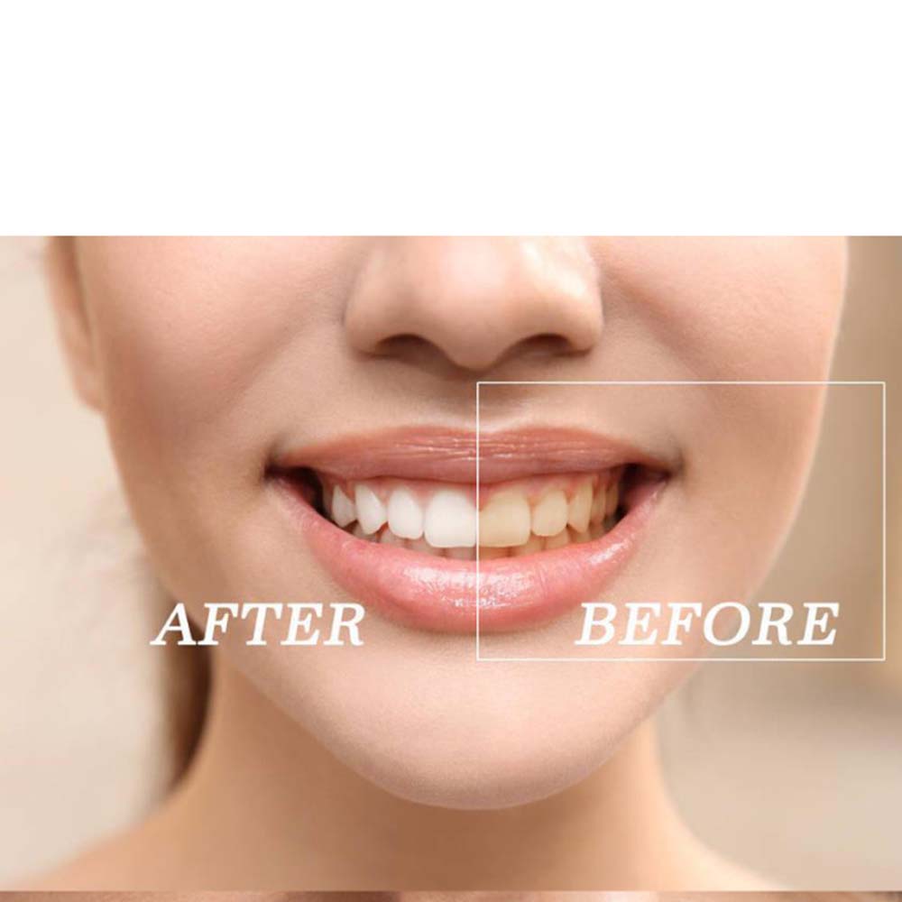 Chất Lượng Hàng Đầu Peroxide L - đánh giá và giá Teeth Whitening Kit With Light