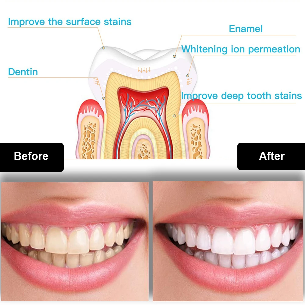 Dental Teeth Whitening Kit Min - đánh giá và giá Teeth Whitening Price
