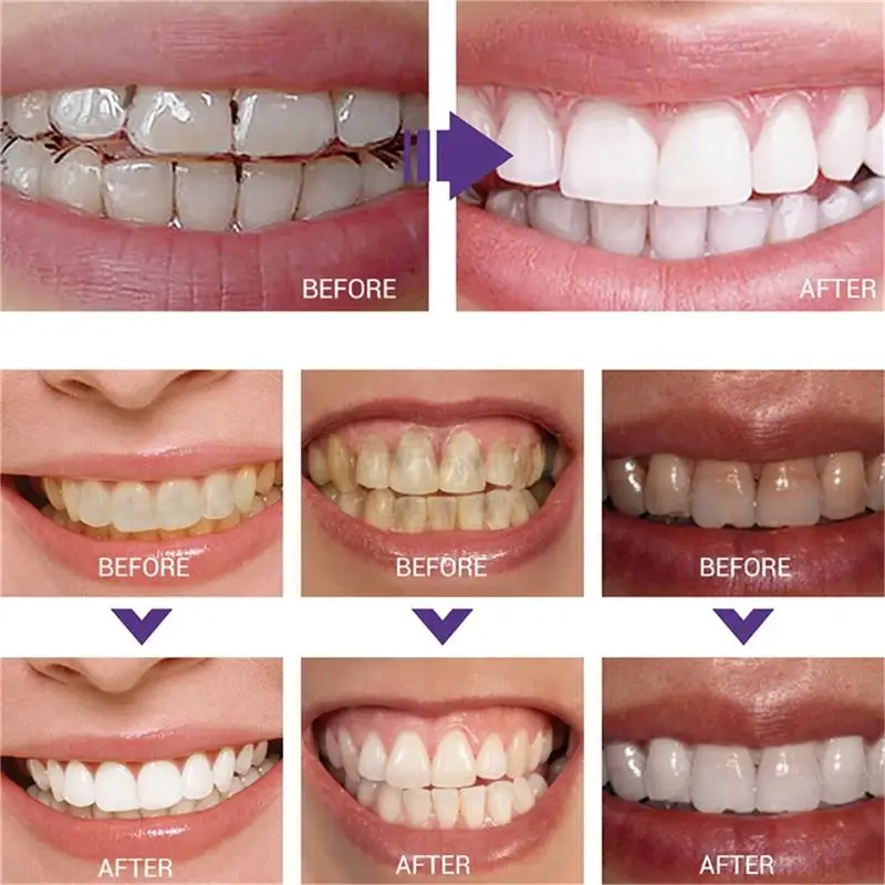 Fast Teeth Whtening Toothpaste - đánh giá và giá Whitening Pen Bleach